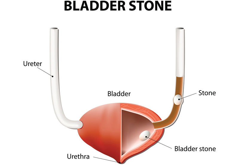 Illustration-of-bladder-stones