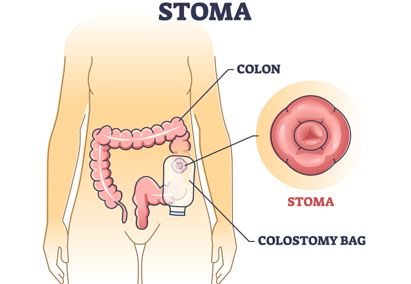 Urinary Stoma Complications