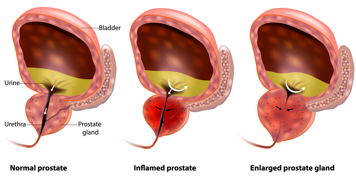 medical-illustration-of-enlarged-prostate